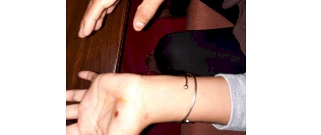 Pelaku, bekas gigitan pelaku di tangan korban, serta ponsel yang dirampas pelaku.