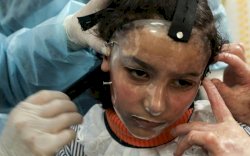 Gadis Gaza Pakai Topeng 3D untuk Sembuhkan Luka Bakar di Wajahnya