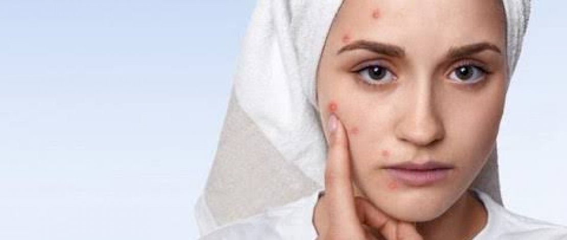 Cara Agar Wajah Terhindar dari Jerawat, Salah Satunya Stop Menyentuh Area Wajah