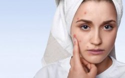 Cara Agar Wajah Terhindar dari Jerawat, Salah Satunya Stop Menyentuh Area Wajah