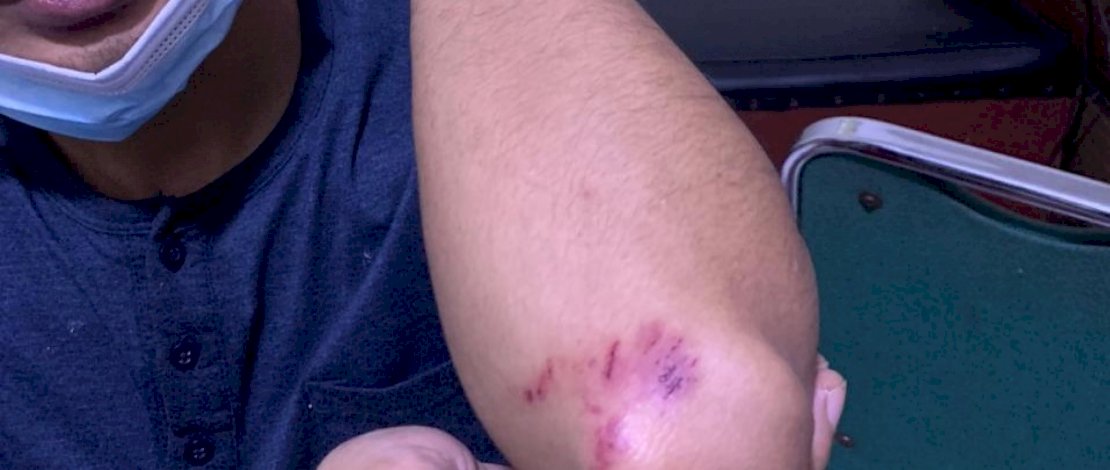 Pelaku penganiayaan, dan korban memperlihatkan luka di sikunya.
