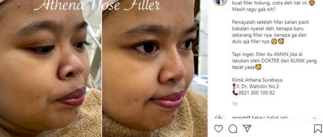 Kekeyi Habis Filler Hidung, Warganet : Cantik Banget, Beb...
