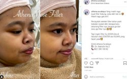 Kekeyi Habis Filler Hidung, Warganet : Cantik Banget, Beb...