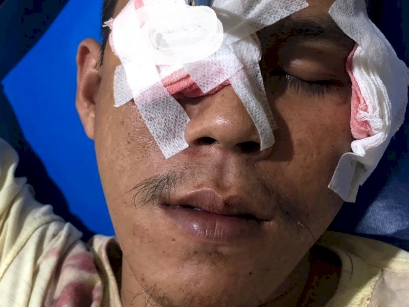 Ihh...Anak Panah Menancap di Mata Kanan Pria Ini Usai Tawuran di Jl Kandea