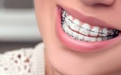 Begini Bahaya Merokok Bagi Pengguna Behel