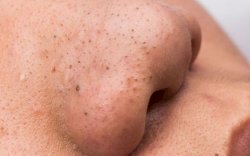 Sembilan Bahan Alami Bantu Hilangkan Komedo di Hidung