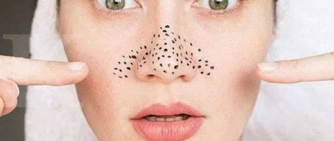 Berikut Cara Menghilangkan Komedo Tanpa Harus ke Klinik Kecantikan