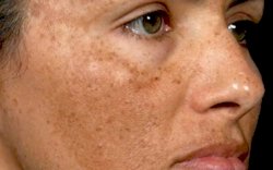 Ini Tips Menghilangkan Flek Hitam di Wajah dengan Bahan Dapur