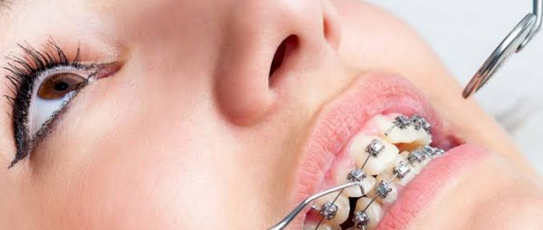 Tips Merawat Gigi Berbehel, Salah Satunya Hindari Makanan Ini