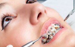 Tips Merawat Gigi Berbehel, Salah Satunya Hindari Makanan Ini