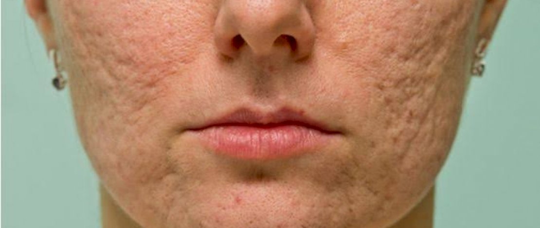 Tips Hilangkan Bopeng dengan Cepat, Dijamin Kamu Semakin Percaya Diri