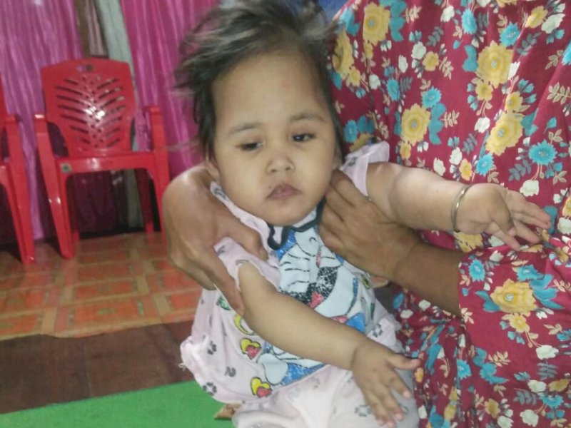 Diduga Kurang Gizi, Balita di Gowa Alami Pembesaran Kepala dan Infeksi