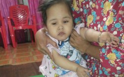 Diduga Kurang Gizi, Balita di Gowa Alami Pembesaran Kepala dan Infeksi