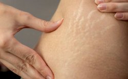 Ini Cara Hilangkan Strech Mark, yang Paling Mudah Rutin Oleskan Krim dan Minyak