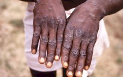 Makin Luas Menyebar, Cacar Monyet di Temukan di UEA dan 20 Negara Lain