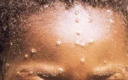 Satu Orang Terindikasi Cacar Monyet di Indonesia Sedang Dirawat di Rumah Sakit