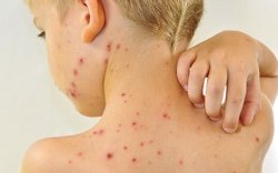 Waspada, Singapura Konfirmasi Kasus Cacar Monyet ke-4