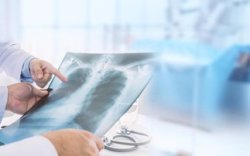 10 Kasus Pneumonia Misterius Muncul di Argentina, Penyebabnya Belum Diketahui