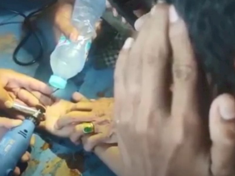 Dicopot Pakai Gurinda, Jari Pelajar di Parepare Membengkak Akibat Cincin Tidak Bisa Lepas 