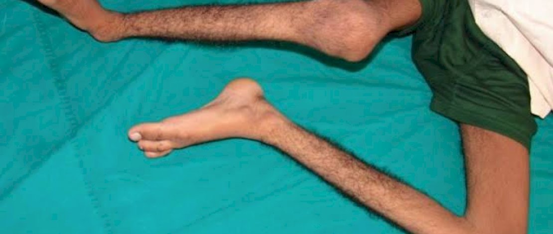 Kemenkes Sebut Buang Air Besar Sembarangan Jadi Salah Satu Penyebab Polio 