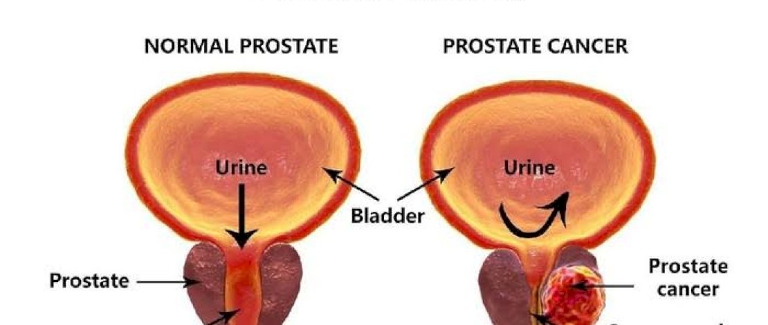 Cegah Kanker Prostat dengan 5 Bahan Alami Ini, Kopi Salah Satunya 