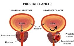 Cegah Kanker Prostat dengan 5 Bahan Alami Ini, Kopi Salah Satunya 