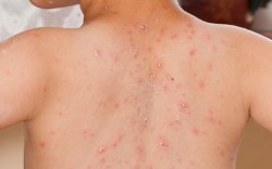 Layanan Imunisasi Tak Capai Target, Kasus Campak Naik 32 Kali Lipat dalam Setahun