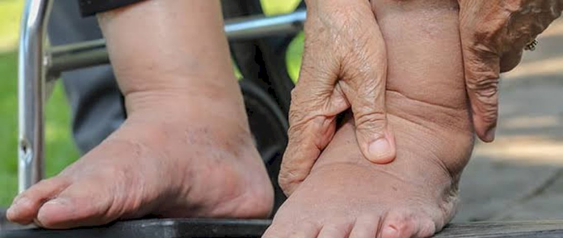 Kemkes Minta Masyarakat Waspada Terhadap Ancaman Penyakit Filariasis Berikut! 