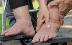 Kemkes Minta Masyarakat Waspada Terhadap Ancaman Penyakit Filariasis Berikut! 