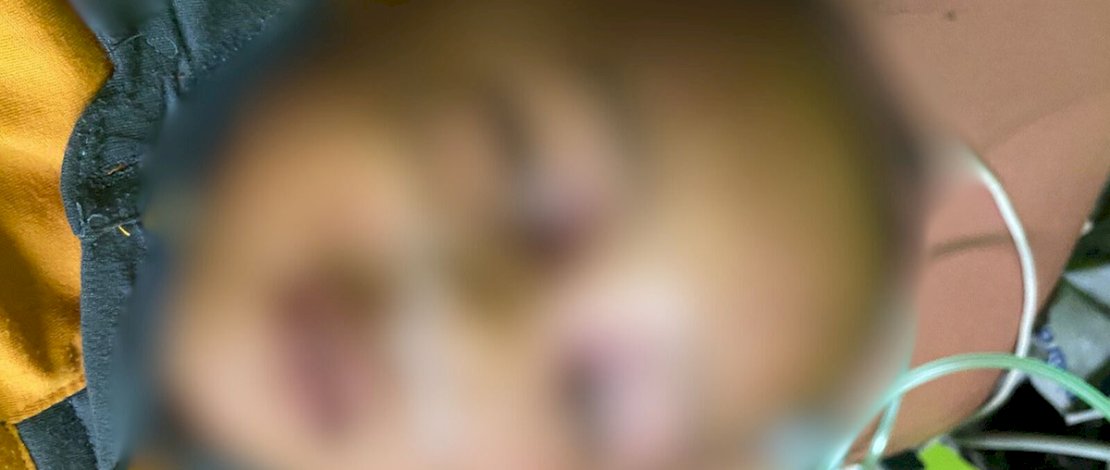 NA merupakan korban penganiayaan yang pelakunya belum diketahui identitasnya, Korban pertama kali ditemukan oleh tante korban bernama Rahma (21).dengan penuh luka memar di sekujur tubuhnya, di Desa Lappa Bosse Kecamatan Kajuara Kabupaten Bone Sulawesi Selatan, Sabtu 27/1/2024 lalu.