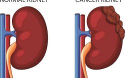 Renggut Nyawa Vokalis 3 Doors Down: Kenalin&nbsp; Kanker Ginjal, Penyakit yang Sering Datang Tanpa Gejala