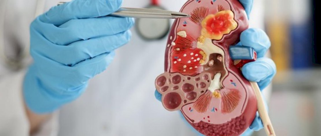 Waspada! 5 Jenis Makanan Ini Bisa Percepat Kerusakan Fungsi Ginjal