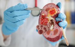 Waspada! 5 Jenis Makanan Ini Bisa Percepat Kerusakan Fungsi Ginjal
