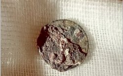 Pria ini Masukkan Koin ke Hidungnya Saat Kecil, Baru Ingat Setelah 53 Tahun