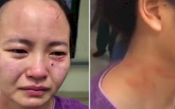 Seorang Perawat Dicakar dan Digigit Pasien Covid-19 yang Menolak Dirawat