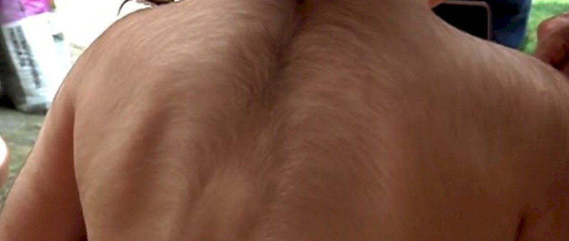 Salah satu anak yang didiagnosis dengan hipertrikosis atau Sindrom Manusia Serigala karena salah diberi obat.