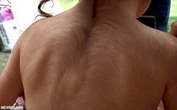 Salah Diberi Obat, 20 Anak-anak Mengalami "Sindrom Manusia Serigala"