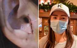 Usai Operasi Hidung, Wanita ini Kaget Bagian Telinganya Malah Hilang